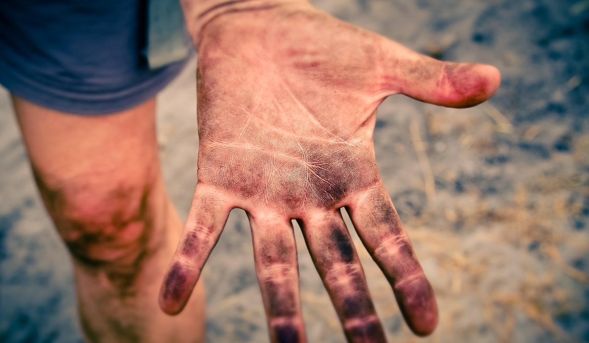 Understanding topical steroid withdrawal claims online